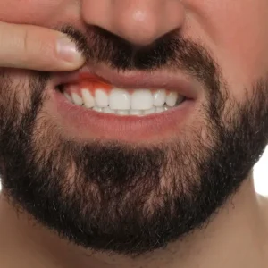 How-to-Prevent-Itchy-Mouth